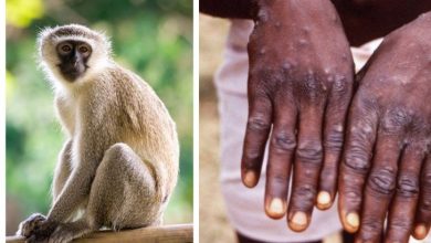 Photo of أعراض الإصابة بجذري القردة الذي يتفشى بسرعة في العالم